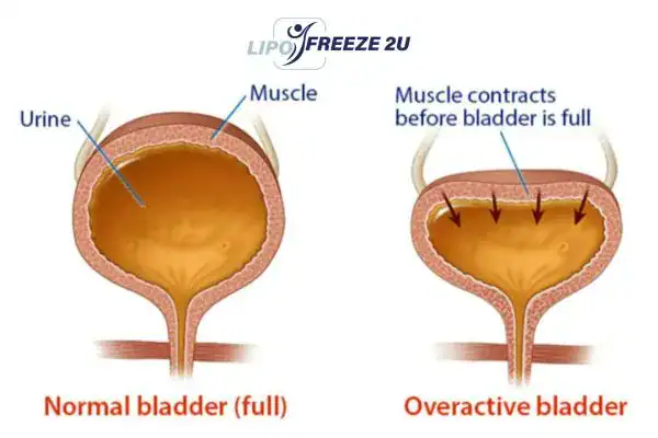 diagram of overactive bladder treatment Wallingford