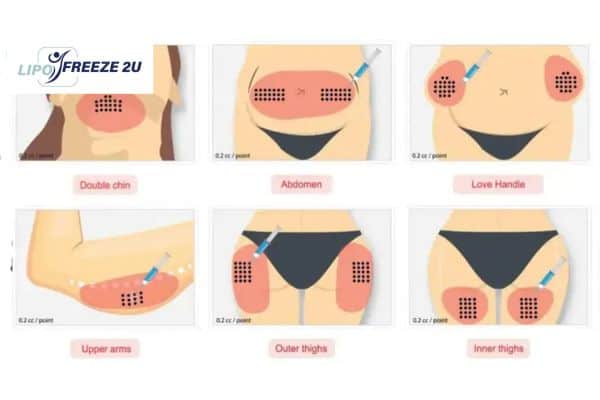 Benefits of Choosing Aqualyx for Fat Reduction Wallingford