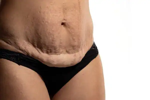 loose skin after weight loss injections Wallingford