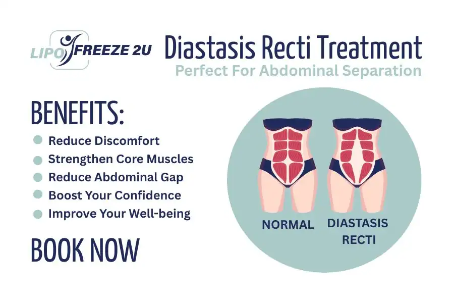 Benefits of body toning treatment Wallingford for Diastasis recti