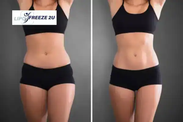 How Can LIPO FREEZE 2U Support Your Post-Pregnancy Body Recovery Wallingford?