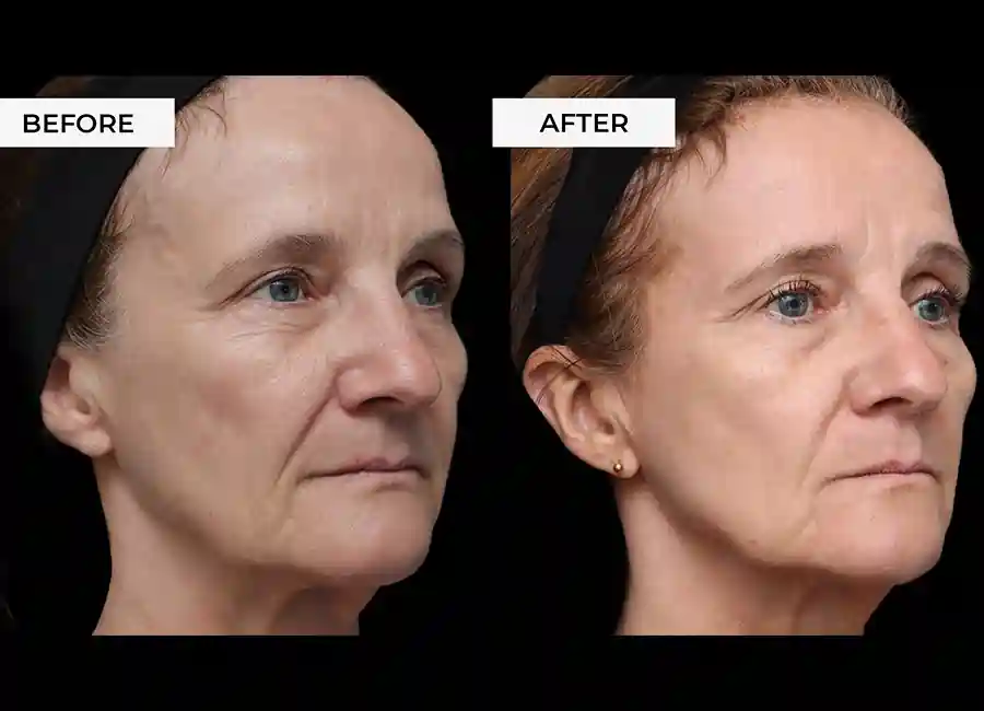 How Many RF Microneedling Sessions Will You Need to See a Difference Wallingford?
