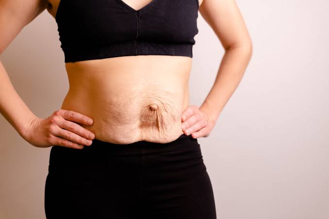 Is Surgery Really the Only Way to Repair Diastasis Recti Wallingford?