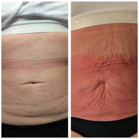 How Does RF Microneedling Improve Crepey, Thin and Uneven Skin Texture Wallingford?