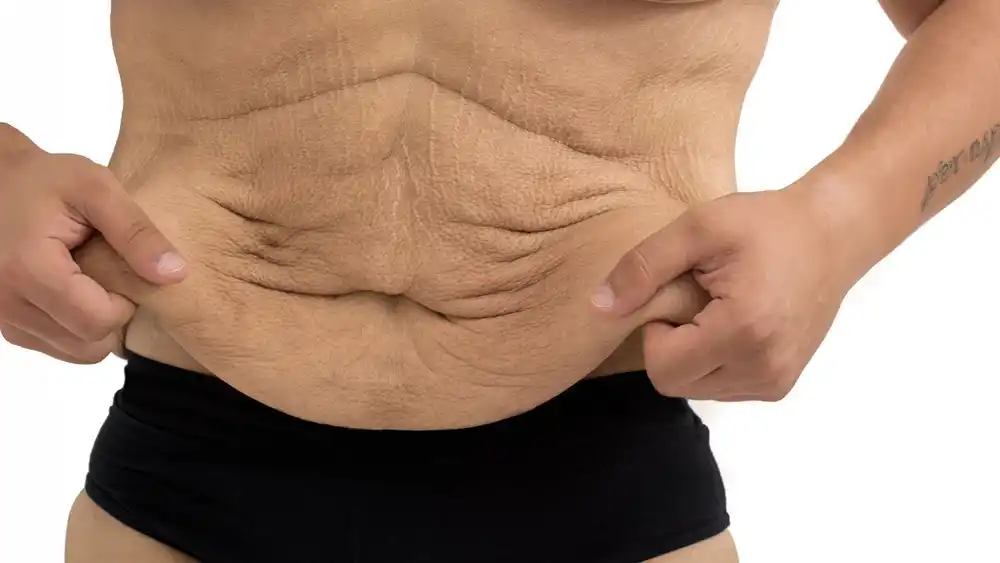 Why Does Weight Loss Medication Leave Some People With Loose or Sagging Skin Wallingford?